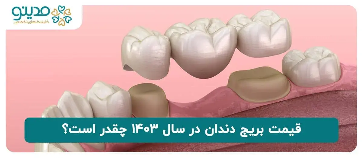 قیمت بریج دندان در سال ۱۴۰۳