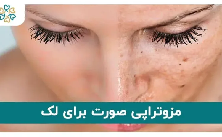  مزوتراپی صورت برای لک