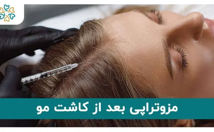  مزوتراپی بعد از کاشت مو