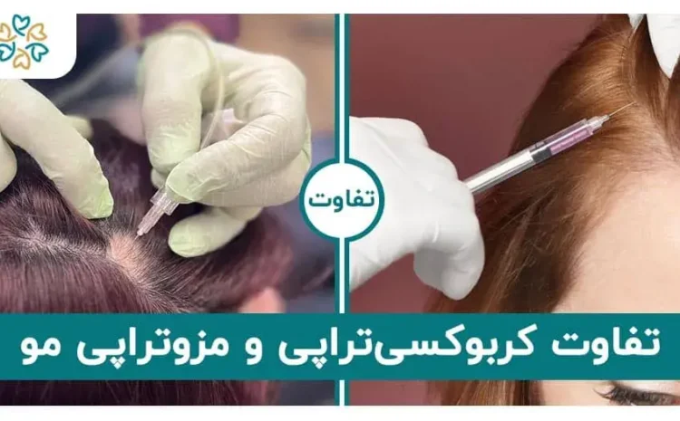  تفاوت کربوکسی‌تراپی و مزوتراپی مو