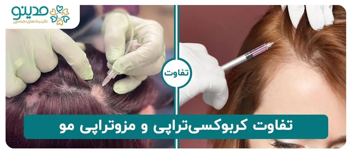 تفاوت کربوکسی‌تراپی و مزوتراپی مو