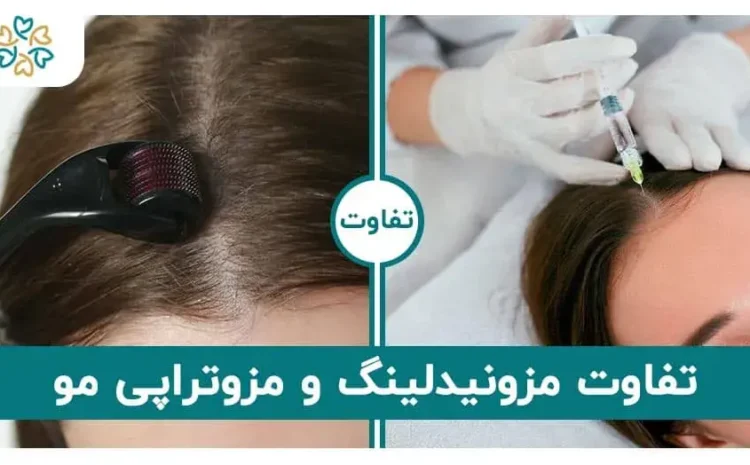  تفاوت مزونیدلینگ و مزوتراپی مو