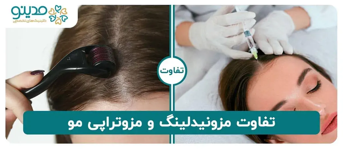 تفاوت مزونیدلینگ و مزوتراپی مو