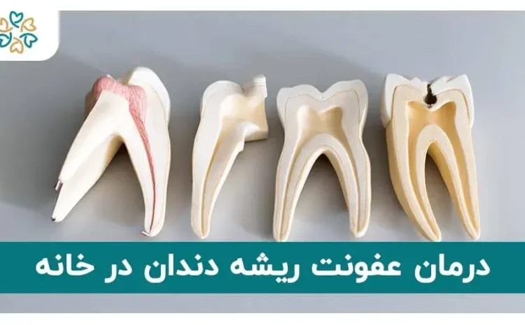  درمان عفونت ریشه دندان در خانه