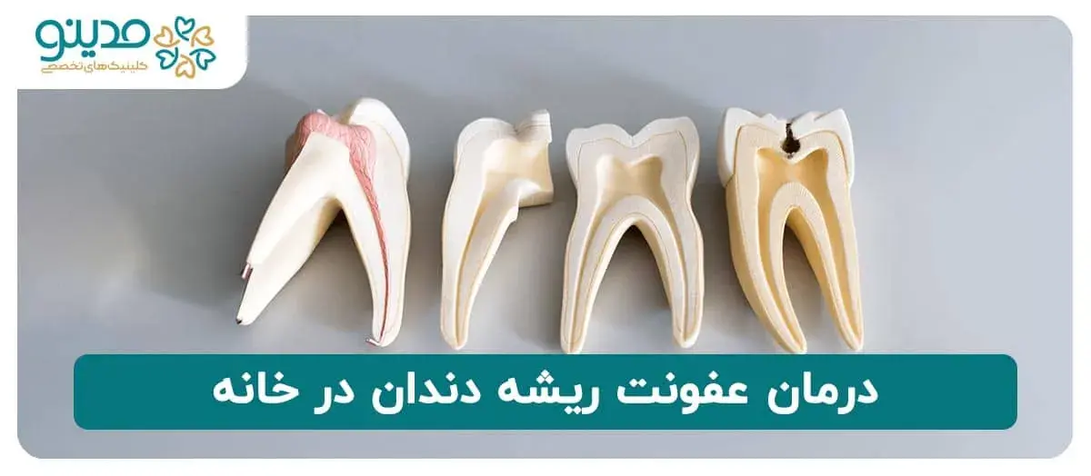 درمان عفونت ریشه دندان در خانه