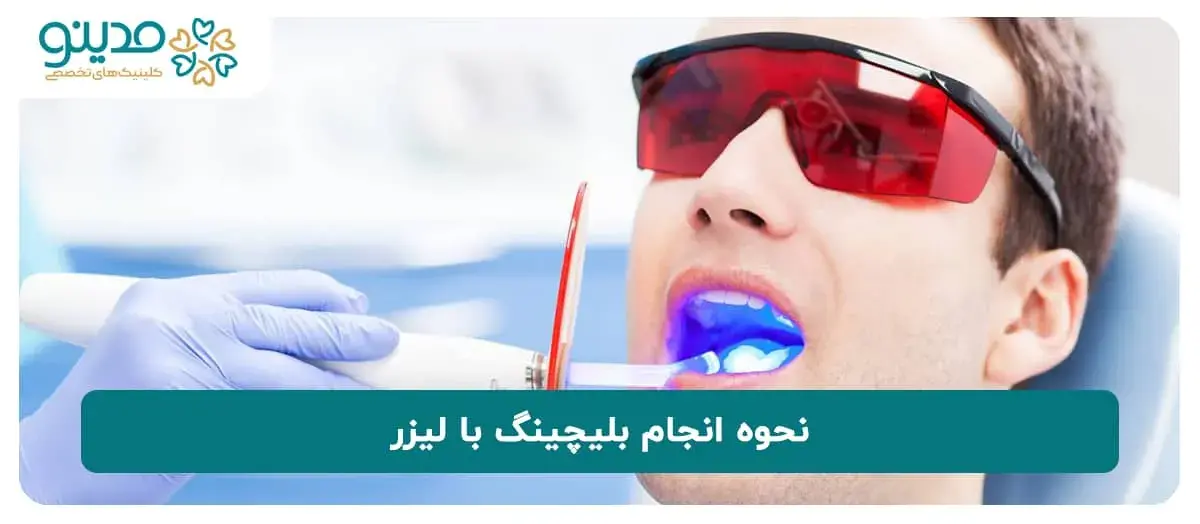 نحوه انجام بلیچینگ با لیزر چگونه است؟