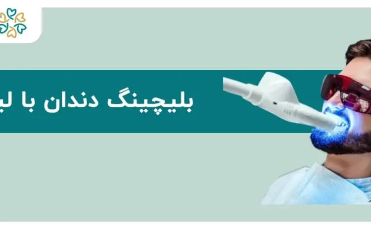  بلیچینگ دندان با لیزر؛ ماندگارتر است؟ [نحوه انجام و قیمت]