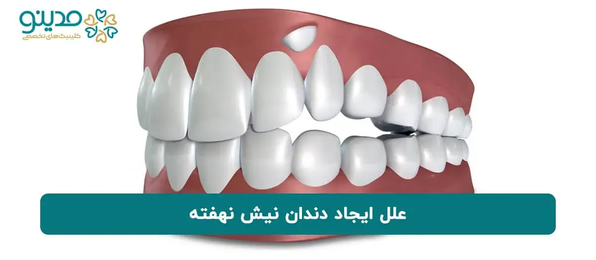 علل ایجاد دندان نیش نهفته