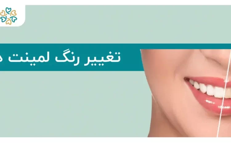  تغییر رنگ لمینت دندان؛ دلایل، روش‌های جلوگیری و راه‌حل‌ها