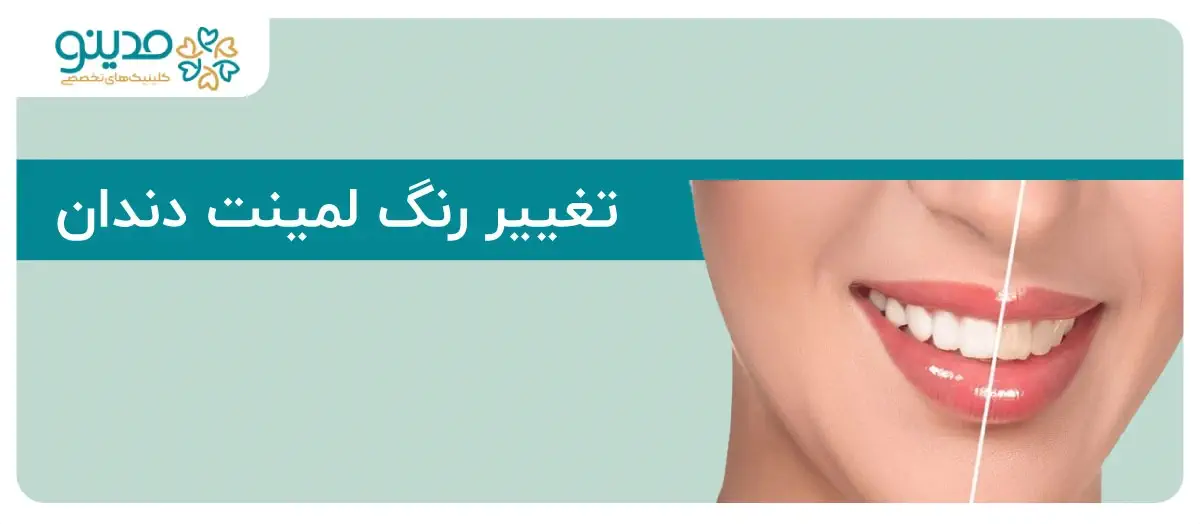 تغییر رنگ لمینت دندان؛ دلایل، روش‌های جلوگیری و راه‌حل‌ها