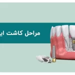 راهنمای جامع مراحل کاشت ایمپلنت دندان