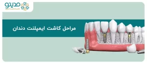 راهنمای جامع مراحل کاشت ایمپلنت دندان