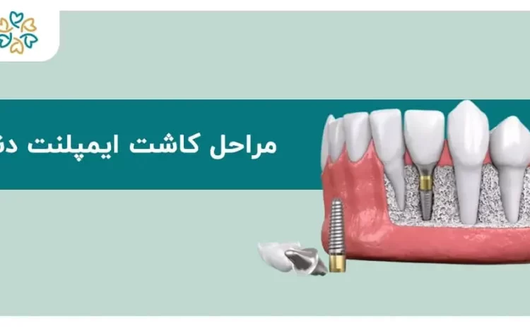  مراحل کاشت ایمپلنت دندان؛ ۵ گام کلیدی تا لبخند کامل