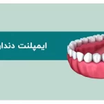 راهنمای جامع تفاوت ایمپلنت دندان با روکش