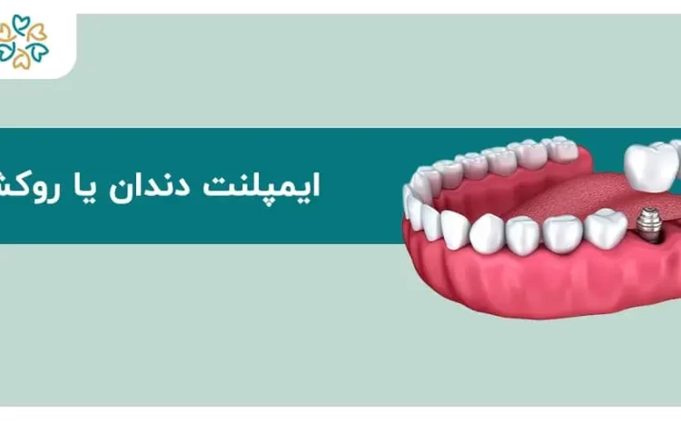  ایمپلنت دندان یا روکش؟ تفاوت‌ها، هزینه؛ کدام بهتر است؟