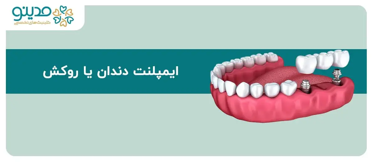 راهنمای جامع تفاوت ایمپلنت دندان با روکش