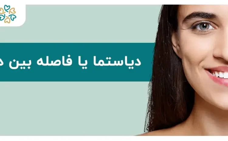  دیاستما یا فاصله بین دندانی؛ علل، درمان‌ها و راه‌های پیشگیری