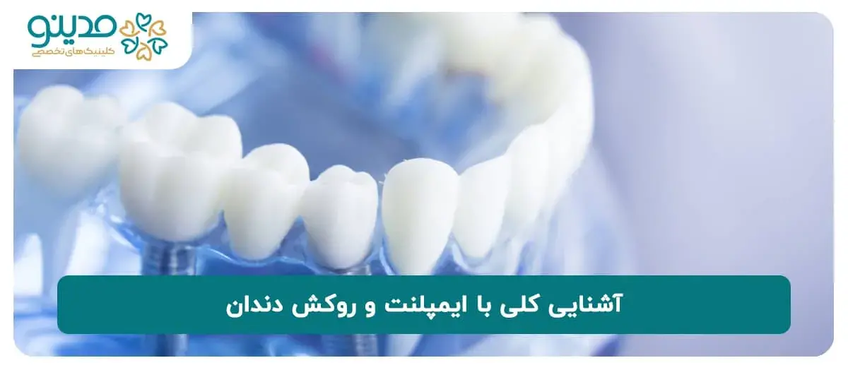 آشنایی کلی با ایمپلنت و روکش دندان