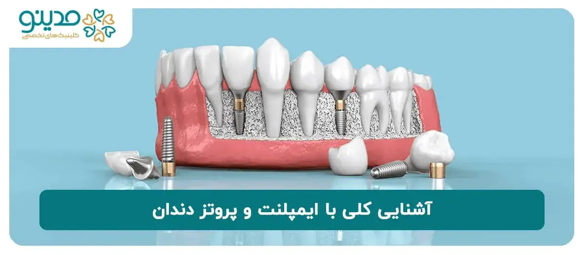 آشنایی کلی با ایمپلنت و پروتز دندان