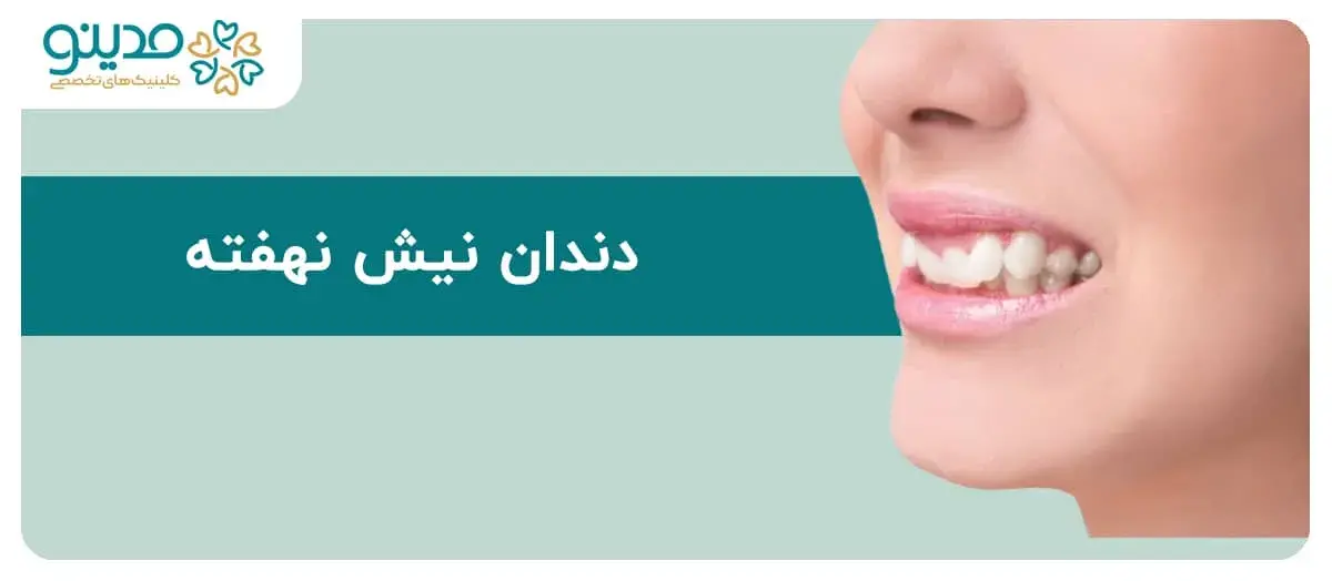 دندان نیش نهفته چیست؟