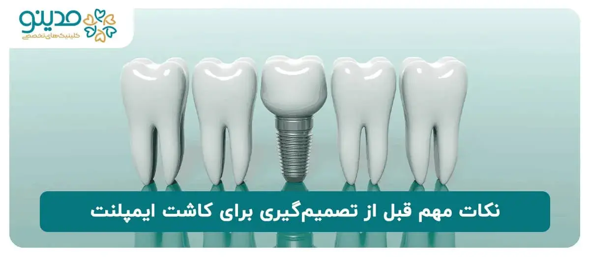 نکات مهم قبل از تصمیم گیری برای کاشت ایمپلنت