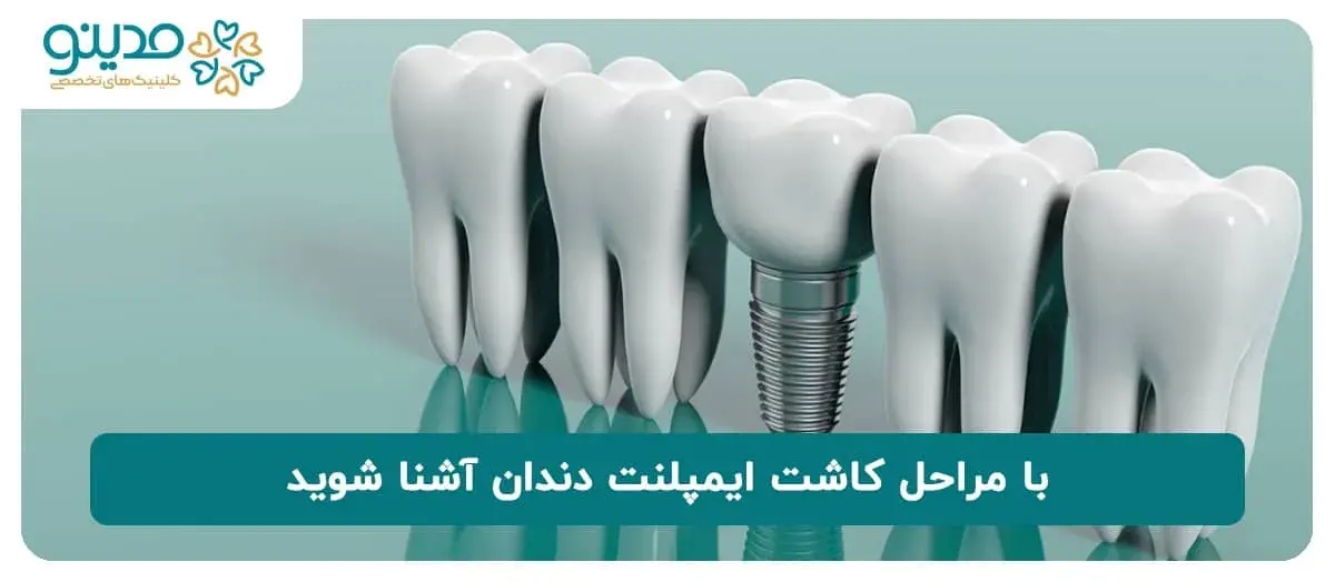 با مراحل کاشت ایمپلنت دندان آشنا شوید