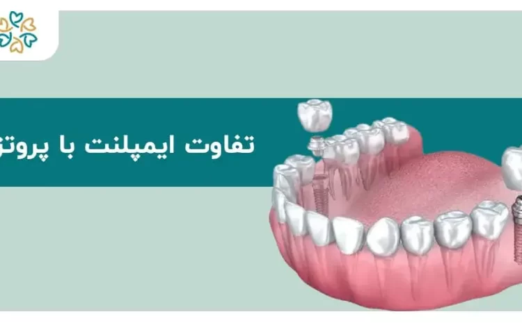  تفاوت ایمپلنت با پروتز دندان؛ کدام انتخاب به‌صرفه‌تر و بادوام‌تر است؟