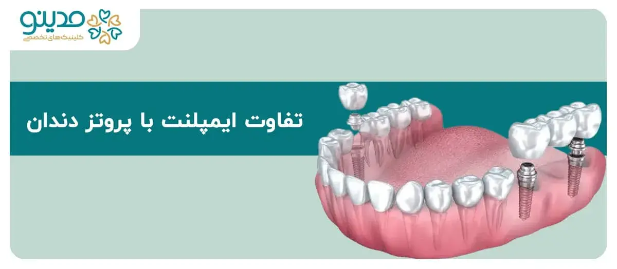 راهنمای جامع تفاوت ایمپلنت با پروتز دندان