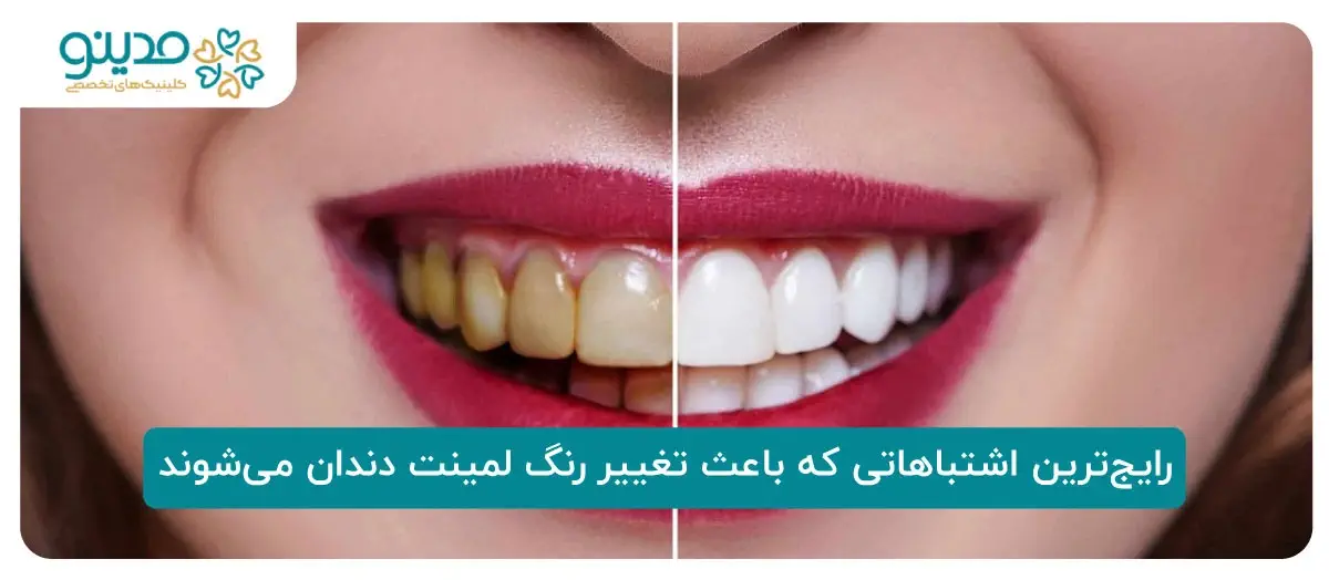 رایج‌ترین اشتباهاتی که باعث تغییر رنگ لمینت دندان می‌شوند