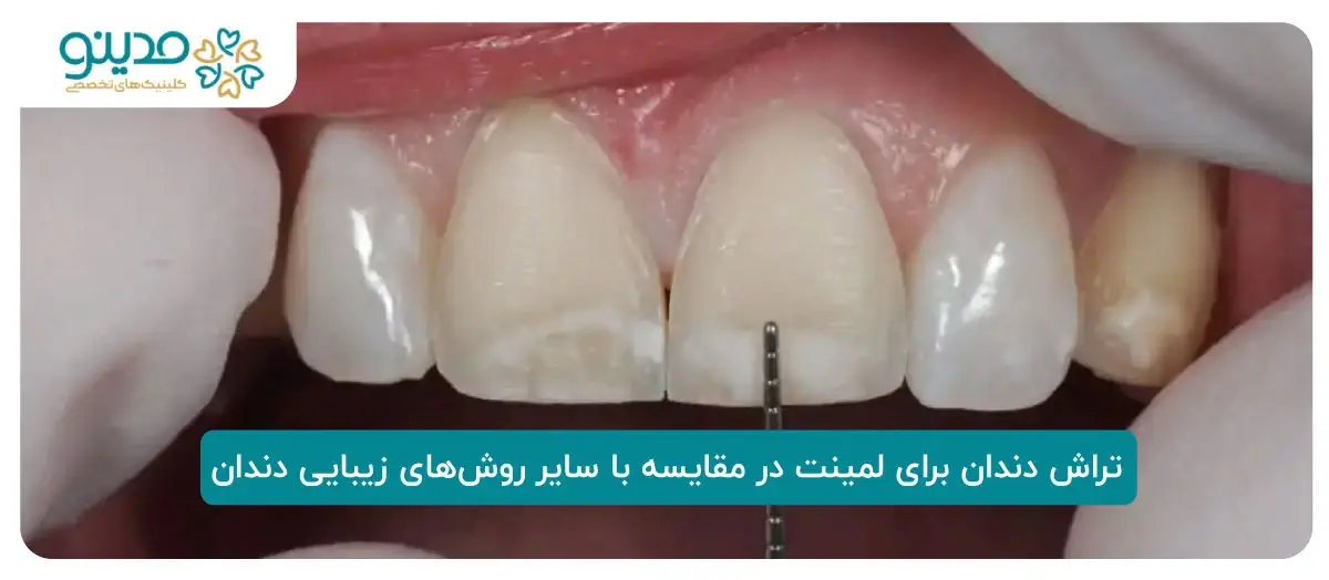 تراش دندان برای لمینت در مقایسه با سایر روش‌های زیبایی دندان