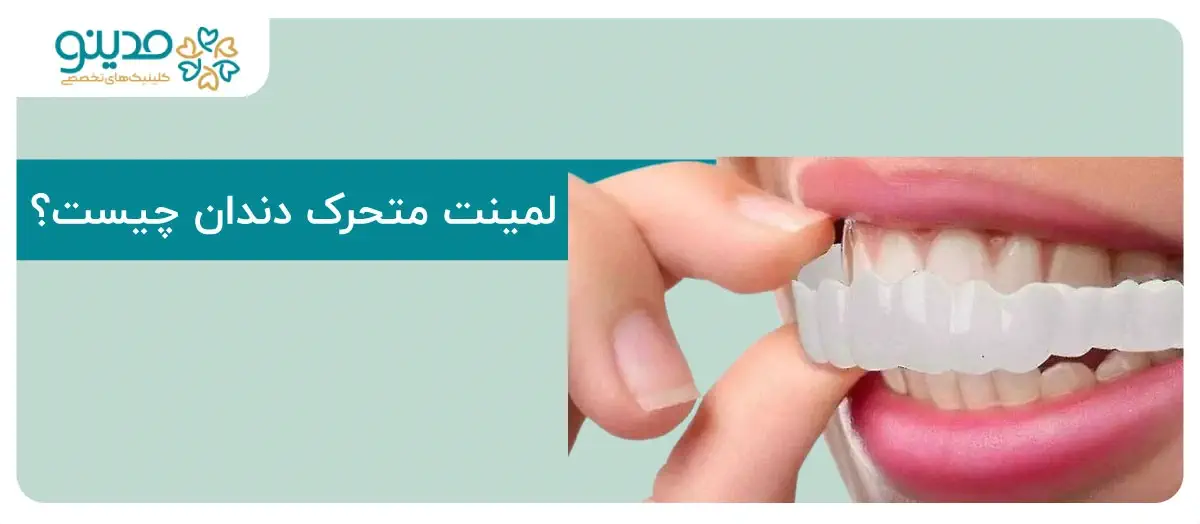 لمینت متحرک دندان چیست؟